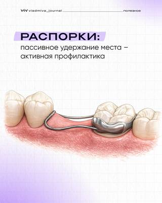 Распорки — проактивный подход к ортодонтии.